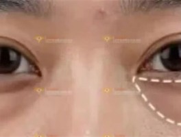 30+重度眼袋，重塑焕亮的秘密直接封神，杏林祛眼袋